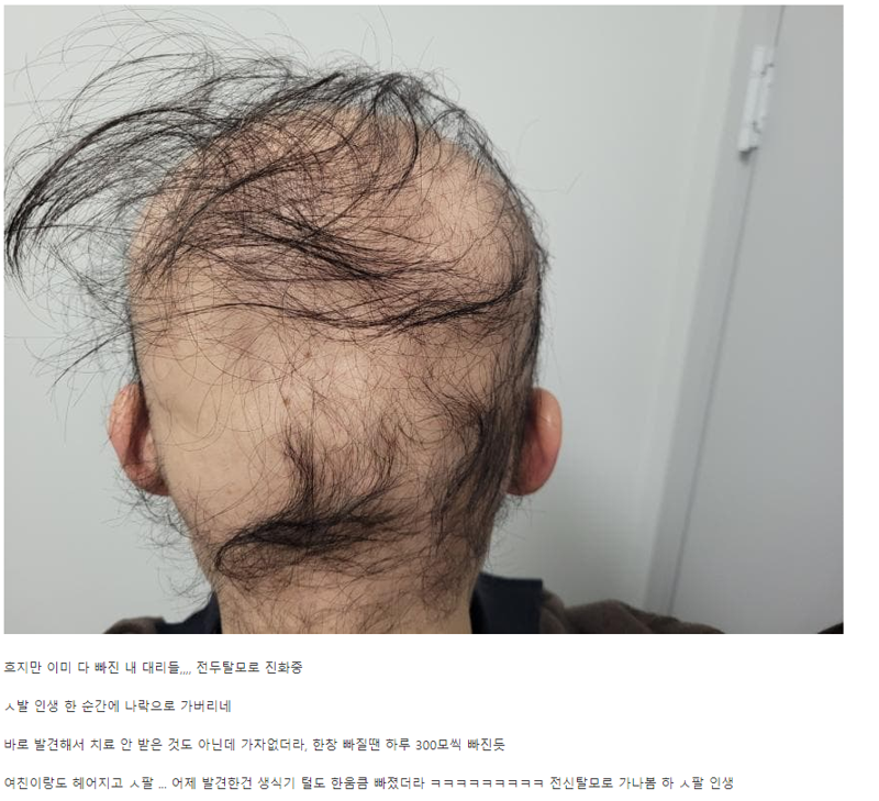 최근 탈모갤에서 핫한 글